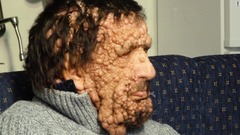 ビニチオさんは皮膚や神経に腫瘍などができる「神経線維腫症Ｉ型」という病気と闘う