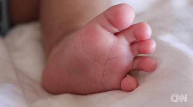 感染症のジカ熱は、乳児の小頭症との関係が疑われている