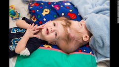 １０月５日：２０１５年に頭部が結合してきた状態で生まれてきた双子。米ニューヨーク市で行われた分離手術の８日前の様子
