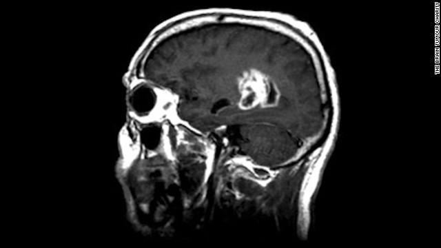 イングランドで脳腫瘍の罹患率が過去２０年で倍増したとの調査結果が発表された