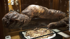 ムター博物館にあるヒルシュスプリング病による慢性便秘で肥大化した大腸　(C)Mutter Museum