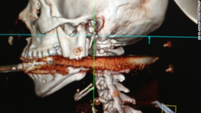 銛は女性の口から入ってのどを突き抜け、頸椎に突き刺さって止まっていた＝リオデジャネイロ衛生当局提供