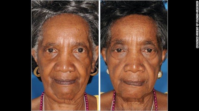 喫煙者・非喫煙者の双子。喫煙歴２９年の女性（右）は目の周りのしわが目立つ＝AMERICAN SOCIETY OF PLASTIC SURGEONS提供