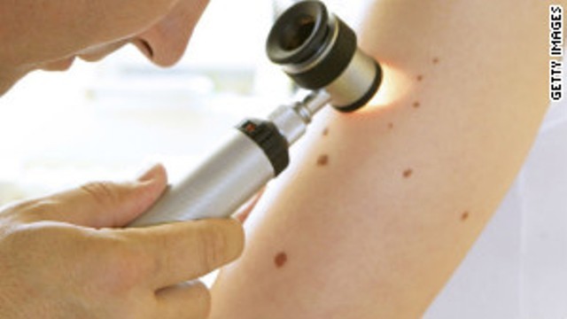 ２つの免疫療法薬が皮膚がん治療の新兵器となるか