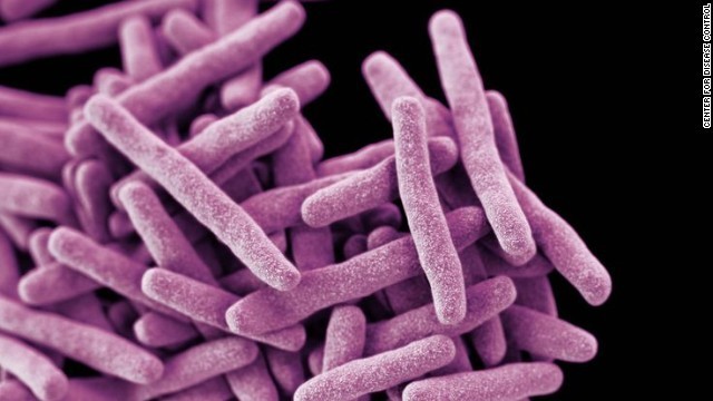 米国で薬剤耐性のある結核菌の感染者が見つかった＝ＣＤＣ
