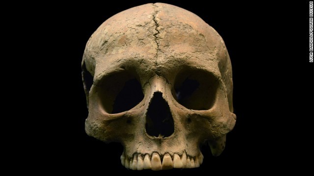 古代ローマ人の歯から採取したＤＮＡから、マラリア感染の証拠が見つかった
