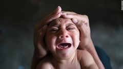 １月３０日：ブラジルで小頭症を持って生まれてきた新生児。ジカウイルス感染症（ジカ熱）の流行は出生時に疾患を持った新生児の急増と関連があるとみられている