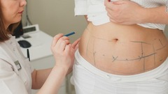 脂肪吸引（２３万５２３７件）：付きすぎた体の脂肪を除去する