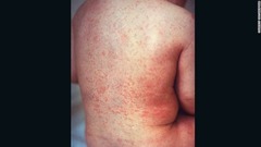 ２０１５年に米州大陸では風疹の根絶が宣言された。しかし、世界的に見ると、毎年約１１万人の赤ちゃんが先天性風疹症候群と診断されている