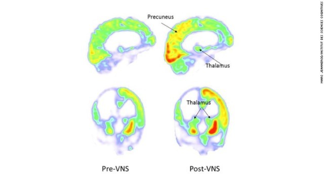迷走神経刺激の前後で脳に表れた変化を示す画像。特定領域で代謝の増加がみられる