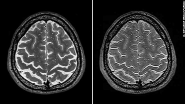 長期滞在した宇宙飛行士の脳の画像。滞在前（左）と後で領域同士の空間が狭まっている