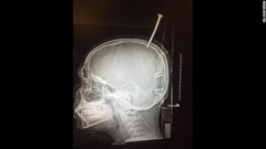 右脳と左脳のちょうど間となる部分に釘の先端が刺さった