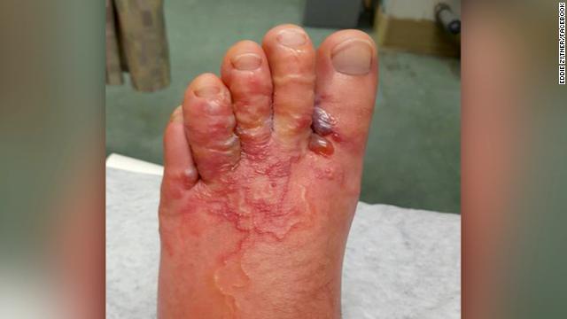 寄生虫が皮膚に入り込み、赤く腫れた左足