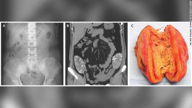 ＣＴスキャンでひも付きの塊が２個見つかり、開腹処置でガーゼのスポンジ２個が腹膜と結腸に付着しているのが確認された