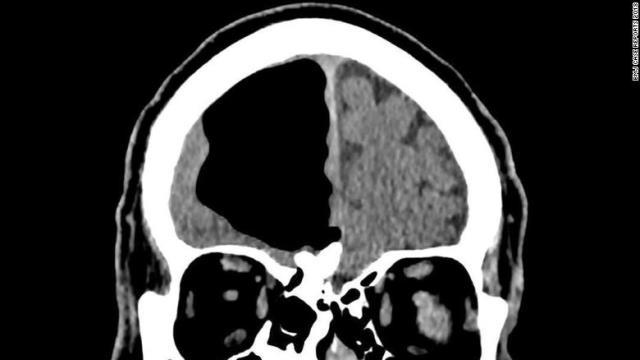 男性の脳内に直径約９センチの空洞があるのが見つかった
