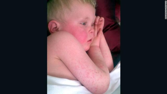 小児に多い感染症「猩紅熱」の報告件数が英イングランドで急増している