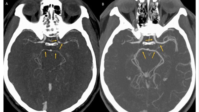 ãä¸çä¸è¾ãããã¦ã¬ã©ã·ãé£ã¹ãç·æ§ã®è³è¡ç®¡ã«ç­çªãè¦ã¤ãã£ã