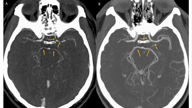 「世界一辛い」トウガラシを食べた男性の脳血管に狭窄が見つかった