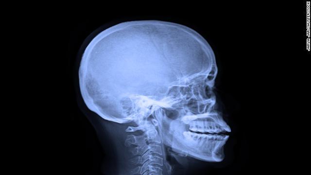 脳震盪などの外傷性脳損傷でパーキンソン病発症のリスクが増大するとの論文が発表された