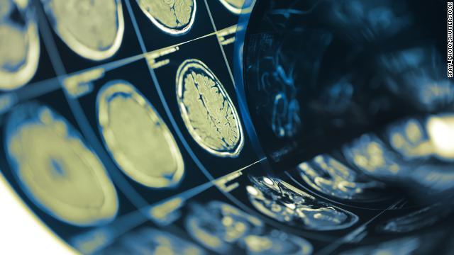 外傷性脳損傷の有無を問わず、パーキンソン病を発症する退役軍人はごく少数にとどまるとの指摘も