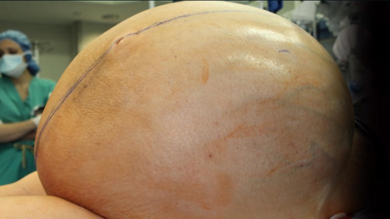 １メートル近くに肥大化した腫瘍を取り除く手術が行われた＝Courtesy Danbury Hospital