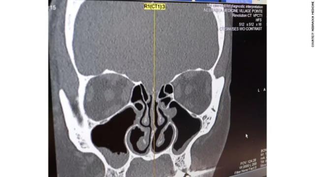 女性患者が、鼻水ではなく脳脊髄液漏れだったと診断された