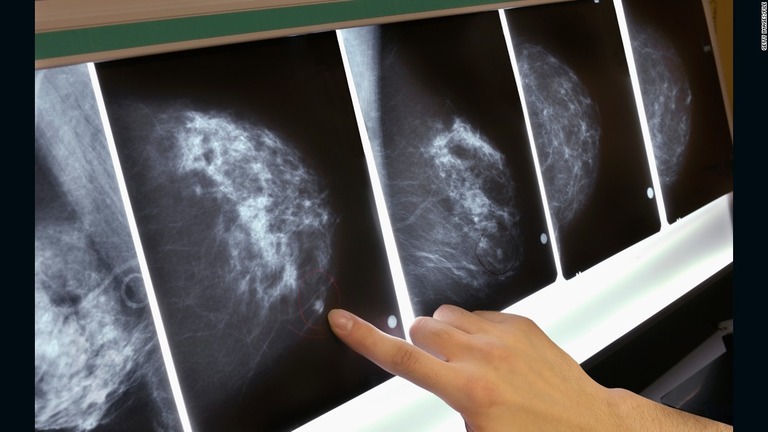 早期乳がんの患者に対する化学療法の必要性について、新たな研究結果が報告された