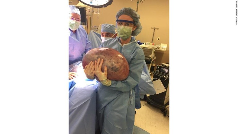 手術で摘出された巨大な嚢胞