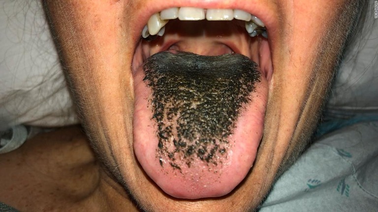 抗生物質を服用した後、黒い毛に覆われたように変色した女性の舌/Yasir Hamad