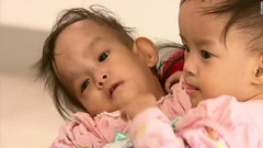 ブータンの結合双生児、豪病院で分離手術へ　医師団は成功に自信