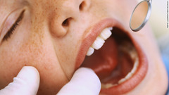 米歯科協会は、キャラメルやグミのような粘着性の高いお菓子について、口の中に長く残って虫歯の原因となるだけでなく、歯の詰め物やかぶせ物が取れる原因になるとして注意を呼びかけている