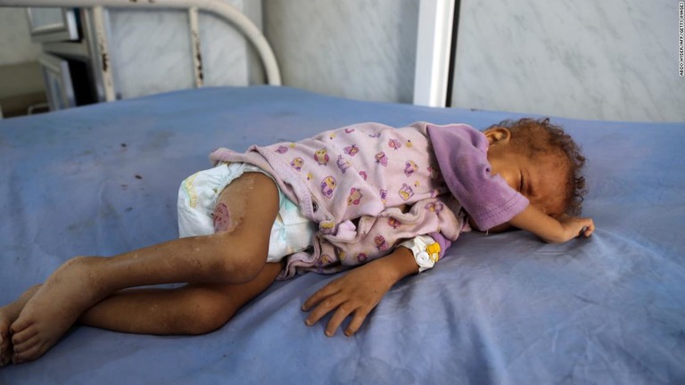 内戦下のイエメンでは、約５０万人の子どもが慢性的な栄養不良状態にある/ABDO HYDER/AFP/Getty Images