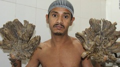 「樹木状」の病変が再発、治療再開へ　バングラデシュの男性