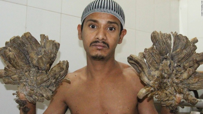 アブル・バジャンダルさんは手足が樹木の枝のようないぼに覆われる皮膚病の治療を受けていたが、再発したため、病院で再治療を受けることになった/Sugam Pokharel/CNN
