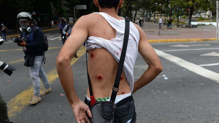 傷跡をみせるデモの参加者＝１月２３日/Federico Parra/AFP/Getty Images