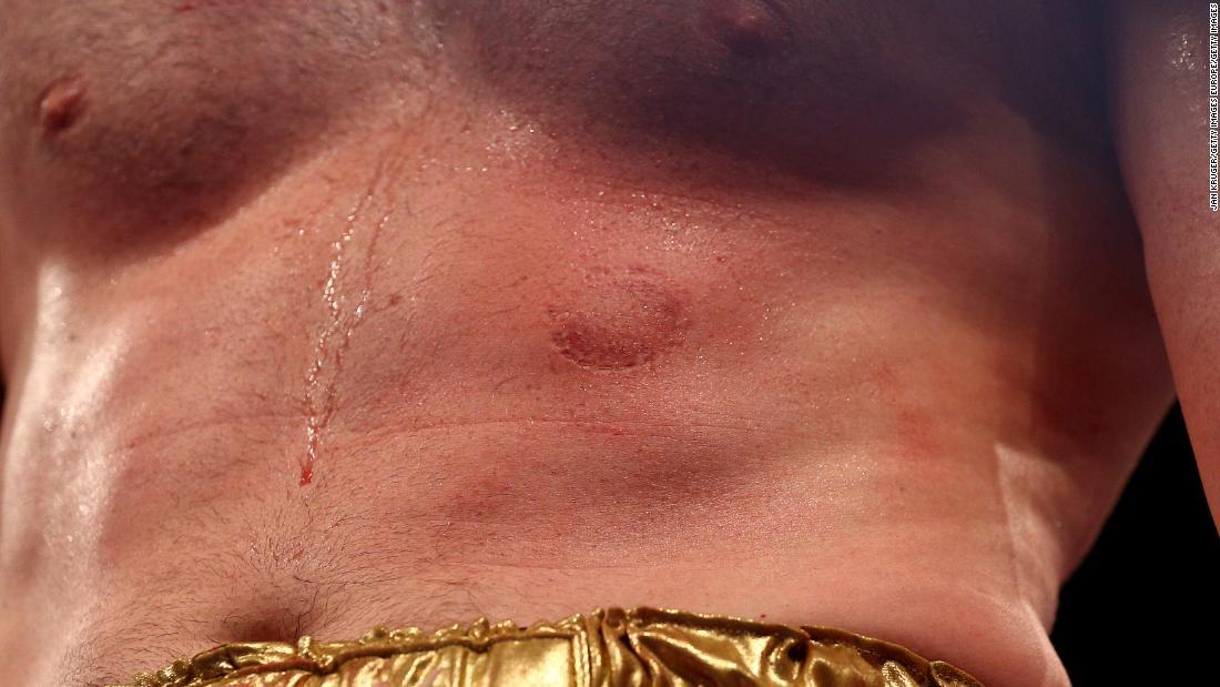 プライスの体に残された噛み痕/Jan Kruger/Getty Images Europe/Getty Images