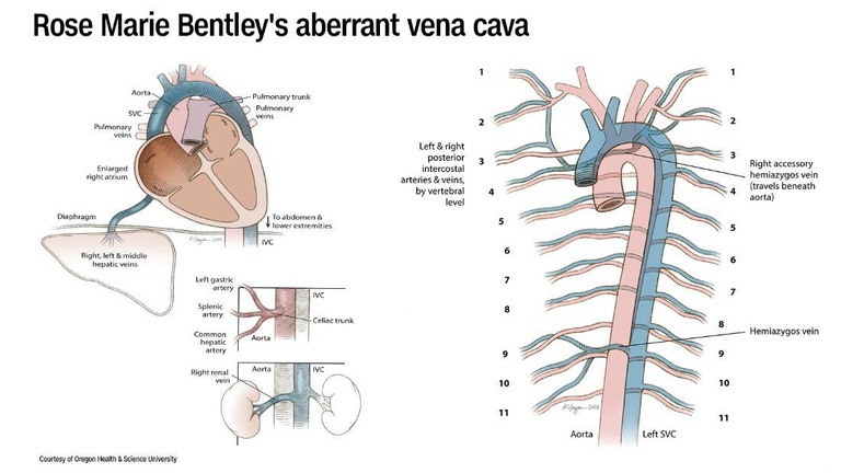 ベントリーさんの大静脈は左側にあったほか、血管の一部は欠けたり普通とは違う場所につながったりしていた