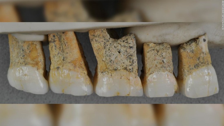 フィリピン・ルソン島で発掘され、ヒト属の新種のものであることが分かった歯の化石/Callao Cave Archaeology Project