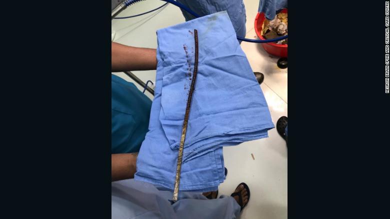1時間半の手術を経て取り除かれた鉄の棒/Neuron Brain Spine and Critical Care Centre