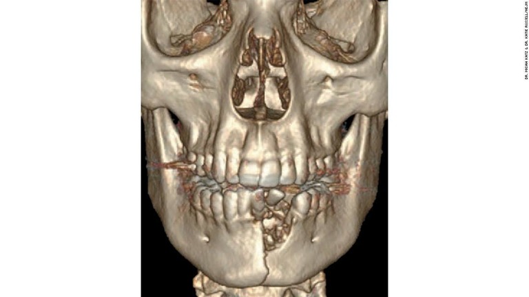 電子たばこの爆発により、米国の１７歳少年があごの骨を粉砕する傷を負った/Dr. Micah Katz & Dr. Katie Russell/NEJM