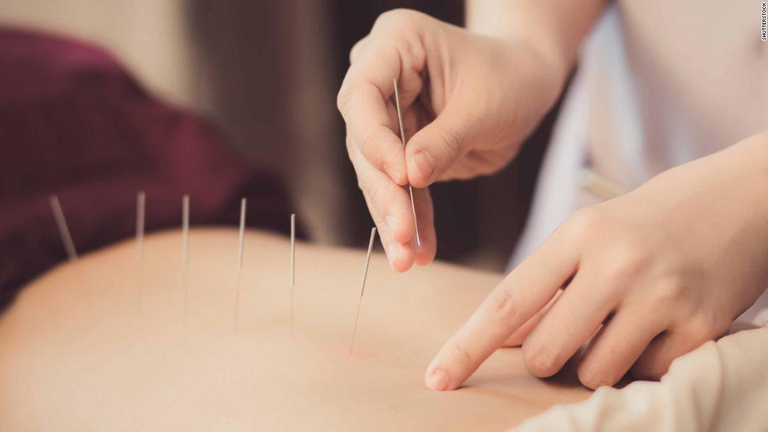 鍼治療も伝統医学の１つ/Shutterstock