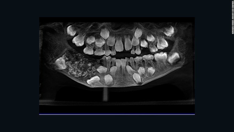 下あごの右側に、大量の「異常な歯」が詰まった嚢（のう）が見つかったという/Saveetha Dental College and Hospital