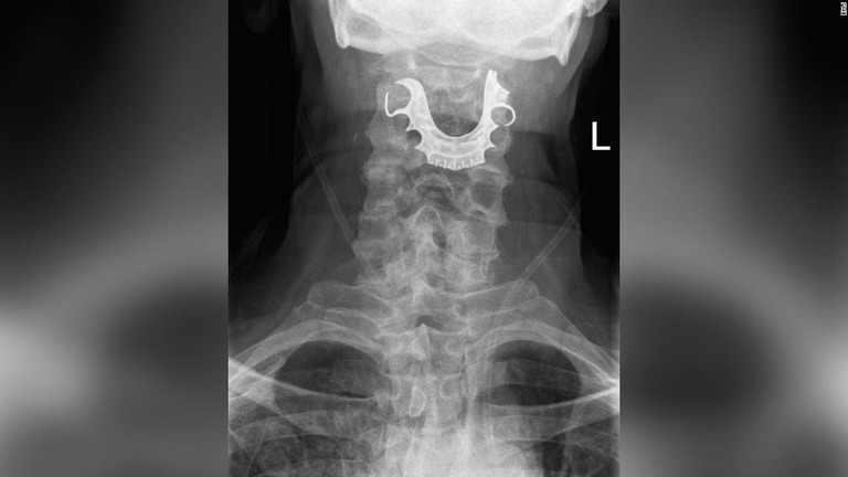 手術中に外れて喉に引っかかった入れ歯の写ったレントゲン写真/BMJ