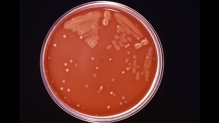 Cnn Co Jp 人食いバクテリアに感染 手術で皮膚の２５ を切除 米男性