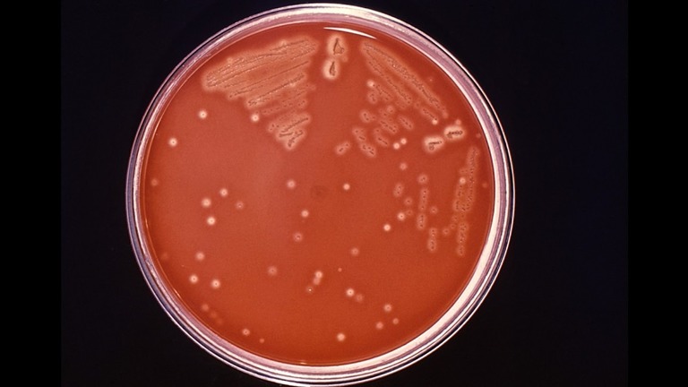 米フロリダ州で男性が肉食性のバクテリアに感染し、手術で皮膚の２５％を切除した