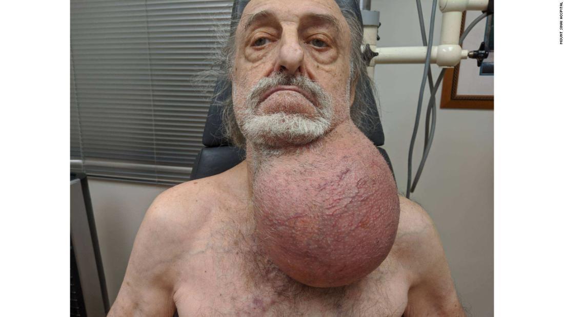 首にサッカーボール大の腫瘍ができた男性/Mount Sinai Hospital
