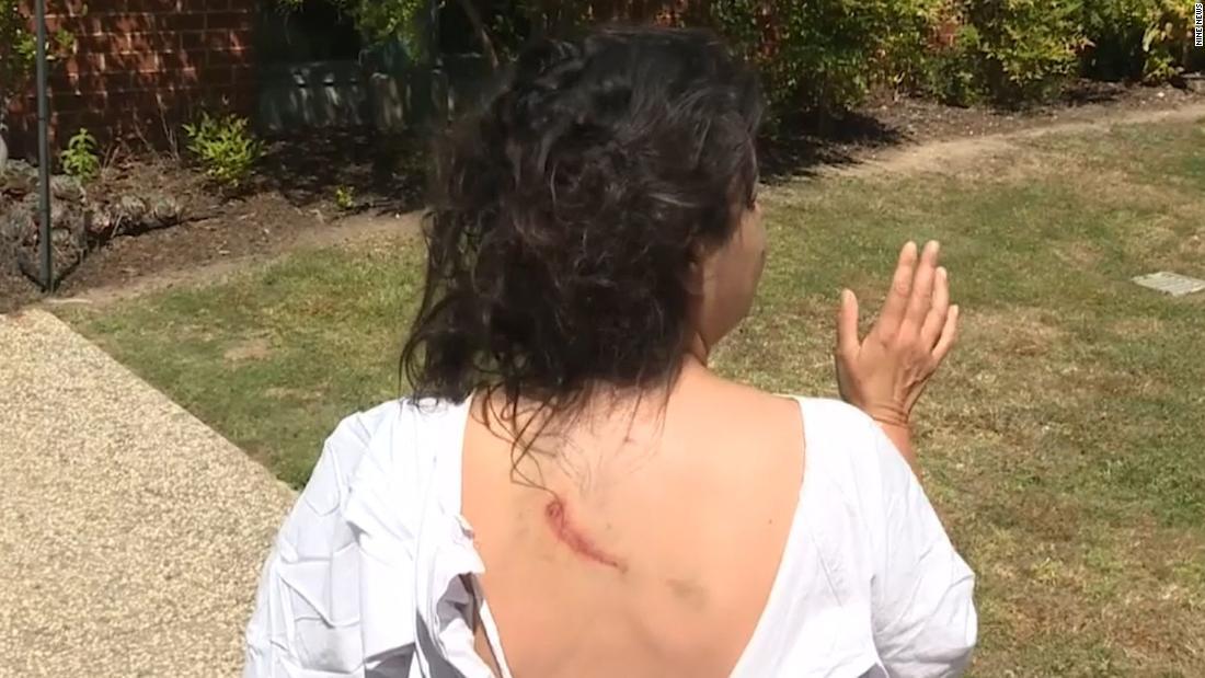 カンガルーに襲われた女性の背中や腕には傷が残った/Nine News