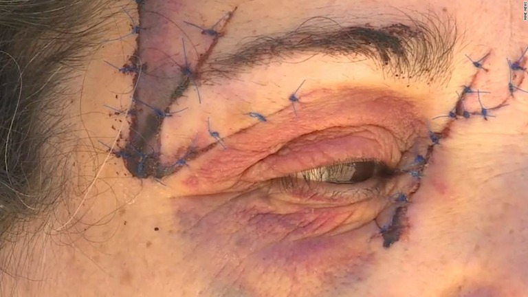 女性がカンガルーに襲われ、顔を２５針縫うけがを負った/Nine News