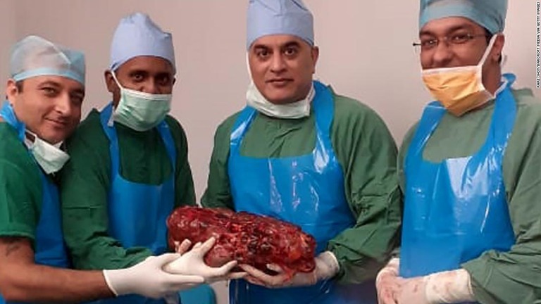 インドで摘出された肥大化した腎臓/Rare Shot/Barcroft Media via Getty Images