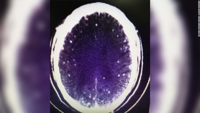 中国で発作などの症状があった男性の脳から寄生虫が見つかった/The First Affiliated Hospital, Zhejiang University